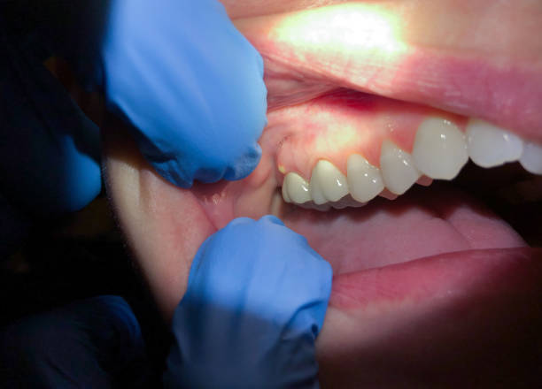 Best Tooth Infection Emergency Dentist  in Blair, NE
